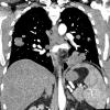 23A4 (Case 23) CT wContrast - Copy