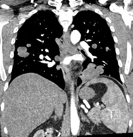 23A4 (Case 23) CT wContrast - Copy