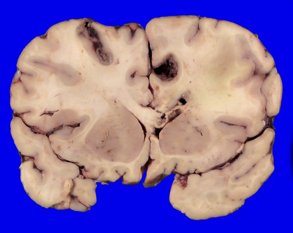 23C2A (Case 23) 010