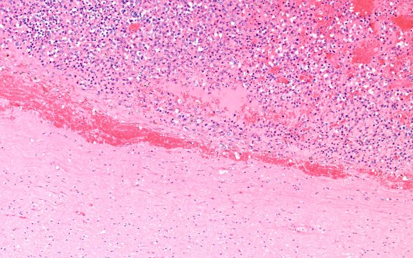 23C4F (Case 23) ) A13 H&E 10X 3