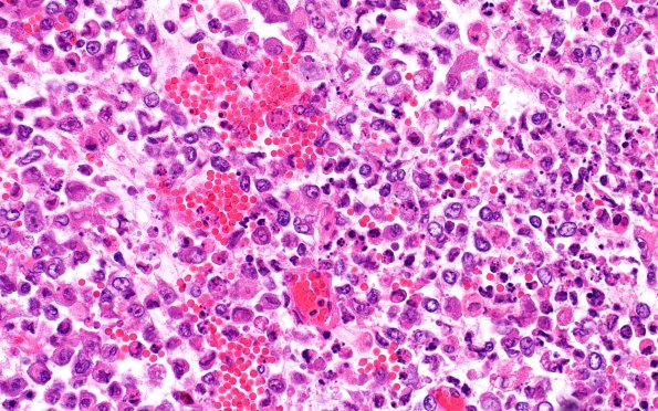 23C6D (Case 23) 19 H&E 40X 3
