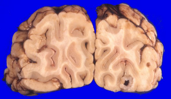 2A2 Metastasis, colon (Case 1) 3