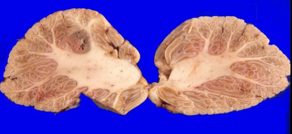 2A3 Metastasis, colon (Case 1) 2