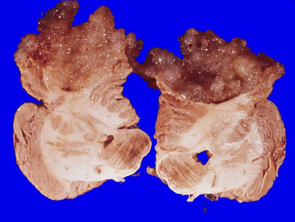 3 Metastases (Case 3) adenoCA