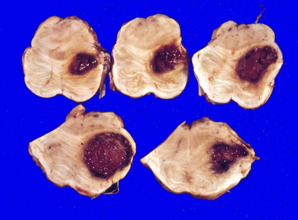 4 Metastases (Case 4) lung adenoCA