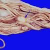 5 Metastases (Case 5) Cauda Equina small cell CA copy