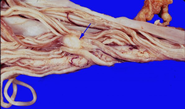 5 Metastases (Case 5) Cauda Equina small cell CA copy