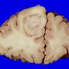 6 Metastases (Case 6)