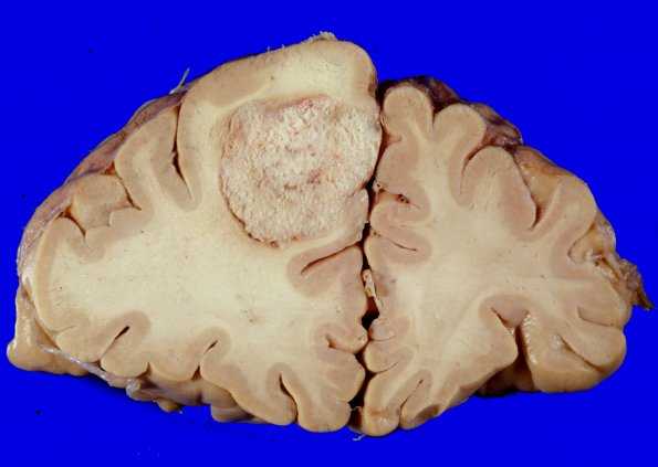 6 Metastases (Case 6)