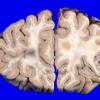 7 Metastases (Case 7)