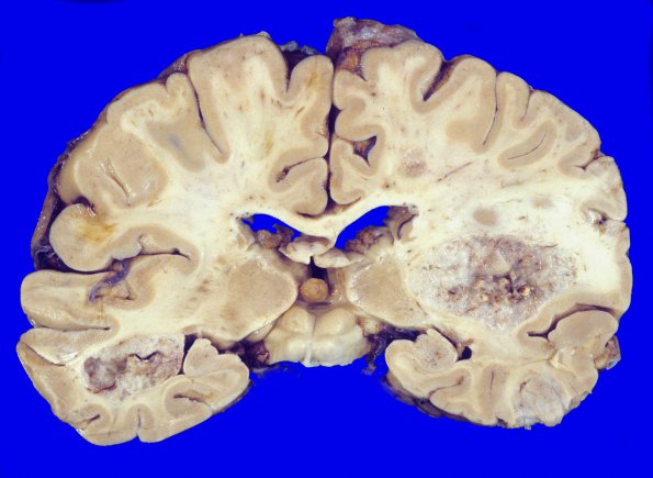 8A1 Metastases, small cell lung (Case 8) 3