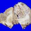 8A2 Metastases, small cell lung (Case 8) 2