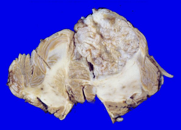 8A2 Metastases, small cell lung (Case 8) 2