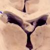 8A3 Metastases small cell lung CA (Case 8) 1 copy