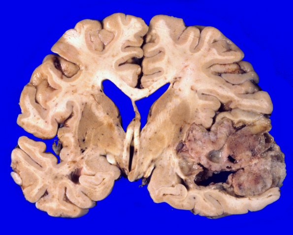 9 Metastases (Case 9) 1