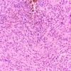 10A1 Melanoma (Case 10) H&E 20X