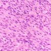 10A2 Melanoma (Case 10) H&E 40X