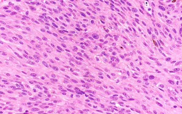 10A2 Melanoma (Case 10) H&E 40X