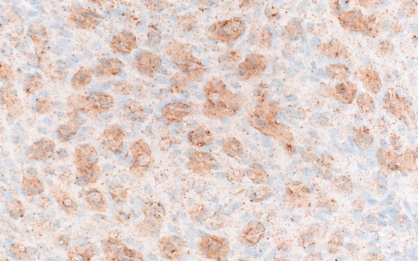 10B3 Melanoma (Case 10) BRAF 40X
