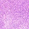 11A1 Melanoma (Case 11) H&E 20X