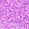 11A2 Melanoma (Case 11) H&E 40X