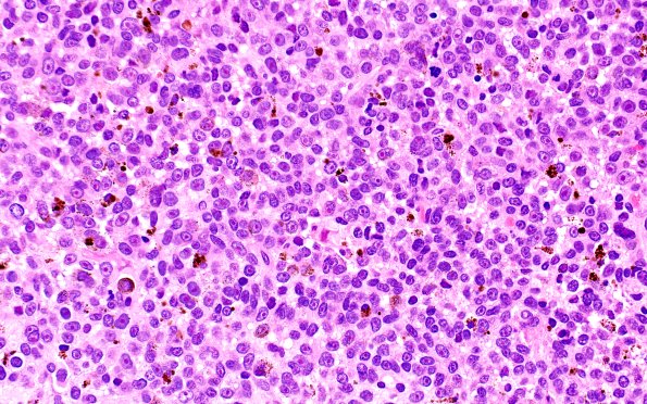 11A2 Melanoma (Case 11) H&E 40X