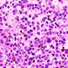11A3 Melanoma (Case 11) H&E 60X 2