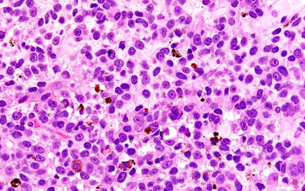 11A3 Melanoma (Case 11) H&E 60X 2