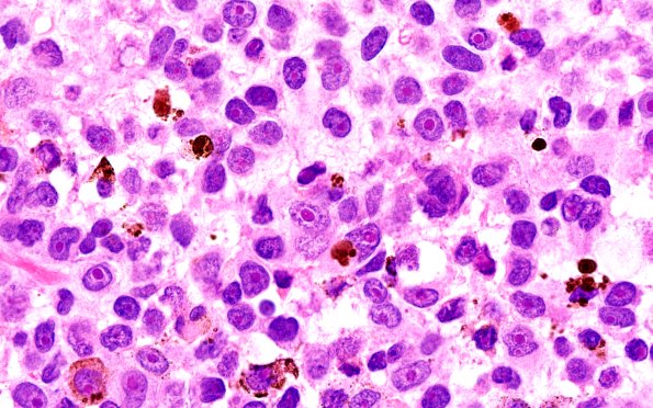 11A4 Melanoma (Case 11) H&E 100X