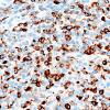 11B Melanoma (Case 11) HMB45 40X