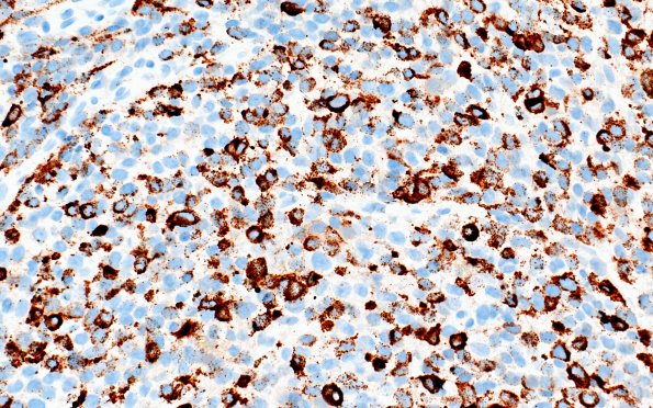 11B Melanoma (Case 11) HMB45 40X