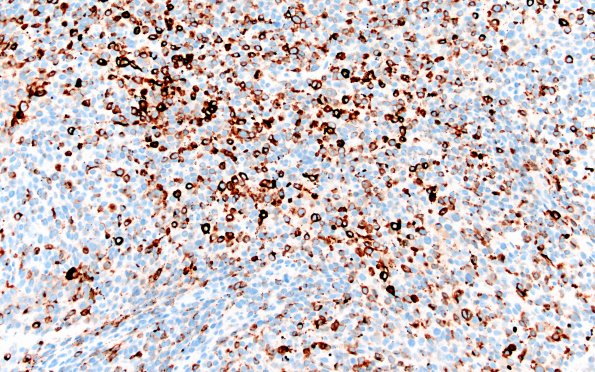 11C1 Melanoma (Case 11) MelanA 20X