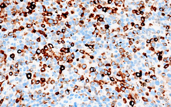 11C2 Melanoma (Case 11) MelanA 40X