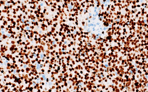 11D Melanoma (Case 11) SOX10 40X
