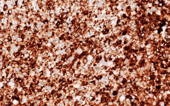 11E Melanoma (Case 11) BRAF 40X