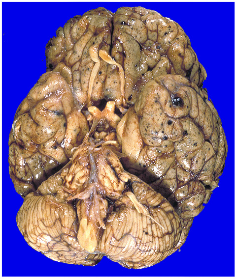 1A1 Metastases Melanoma (Case 1) 3A