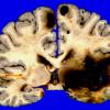 1A2 Metastases Melanoma (Case 1) 2