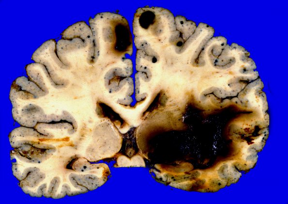 1A2 Metastases Melanoma (Case 1) 2