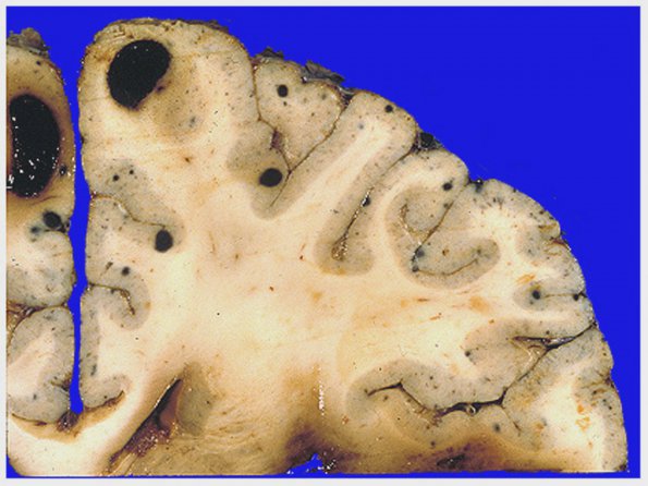 1A3 Metastases Melanoma (Case 1) 4A