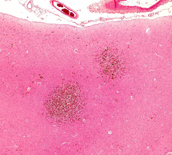 1B1 Metastases Melanoma (Case 1) H & E 4.jpg