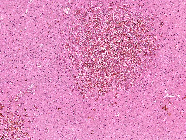 1B2 Metastases Melanoma (Case 1) H & E 2.jpg