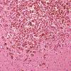 1B3 Metastases Melanoma (Case 1) H & E 3.jpg