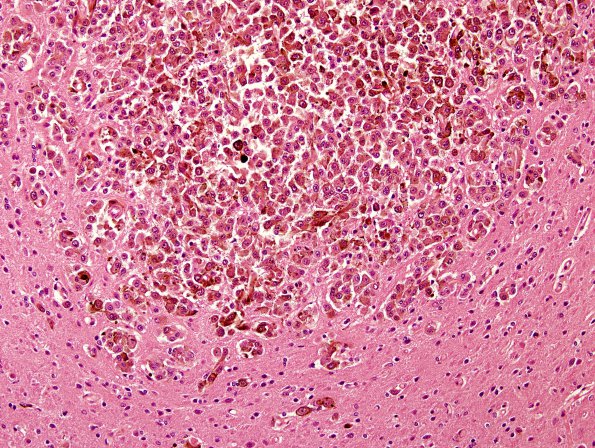 1B3 Metastases Melanoma (Case 1) H & E 3.jpg