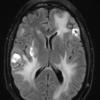 2A1 Metastases, melanoma (Case 2) Flair 2 - Copy