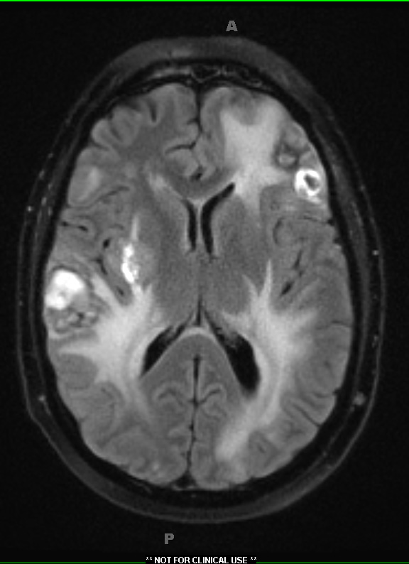 2A1 Metastases, melanoma (Case 2) Flair 2 - Copy