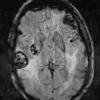 2A2 Metastases, melanoma (Case 2) SWI 1 - Copy