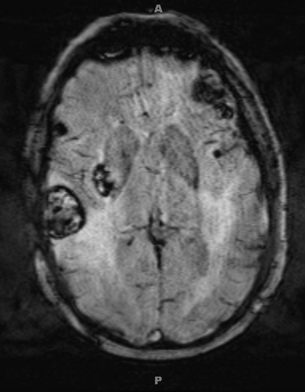 2A2 Metastases, melanoma (Case 2) SWI 1 - Copy