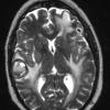 2A3 Metastases, melanoma (Case 2) T2 W 1 - Copy