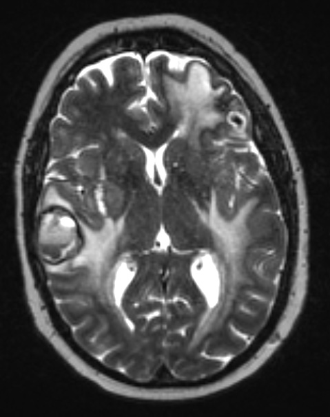 2A3 Metastases, melanoma (Case 2) T2 W 1 - Copy