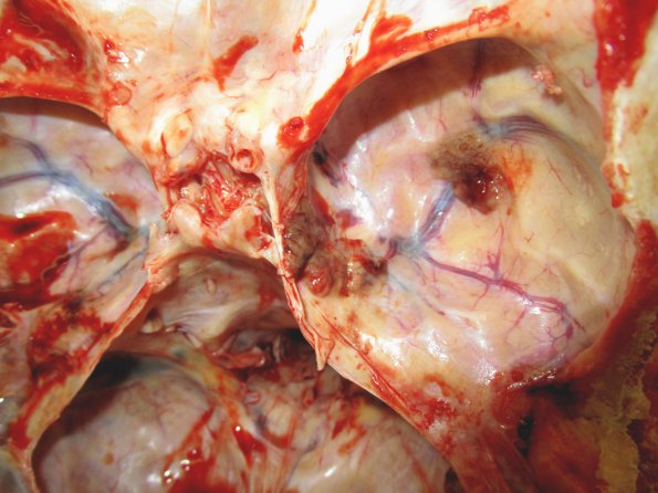 2B1 Metastases, melanoma (Case 2) _4